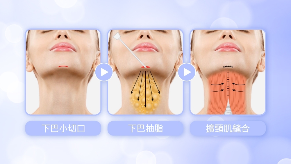 晶鑽診所 天鵝頸手術的原理