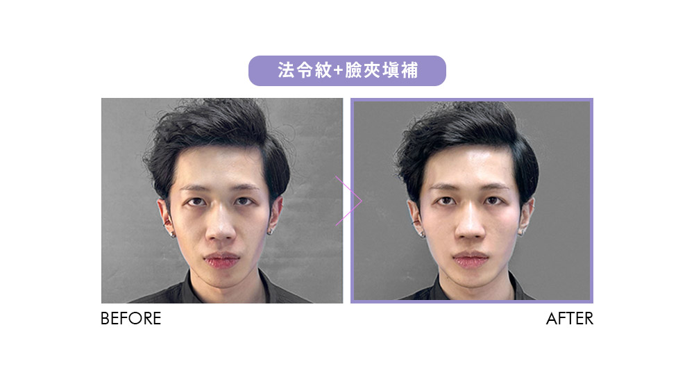 晶鑽診所 緹奧希 玻尿酸 臉部除皺 臉部填補 淚溝填補 木偶紋法令紋填補