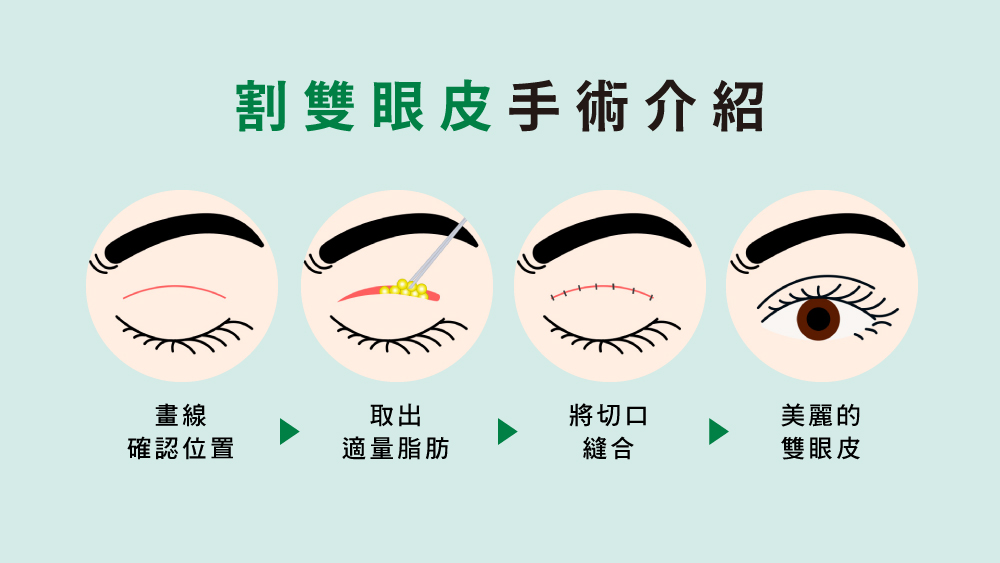 晶鑽診所  雙眼皮手術有哪些