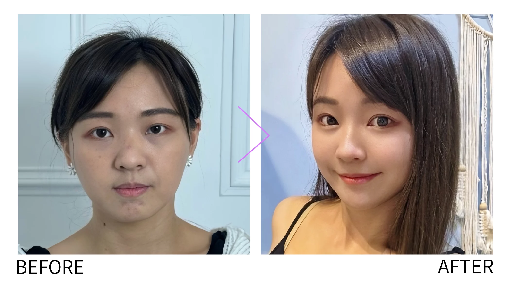晶鑽診所 複合式臉部拉提 