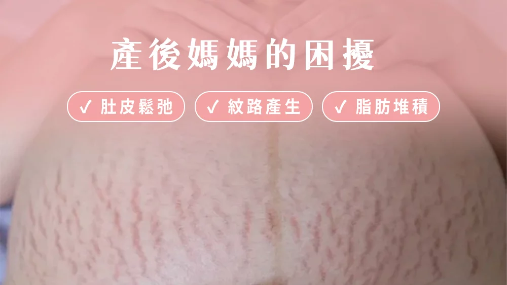 晶鑽診所 改善妊娠紋產後媽媽的困擾