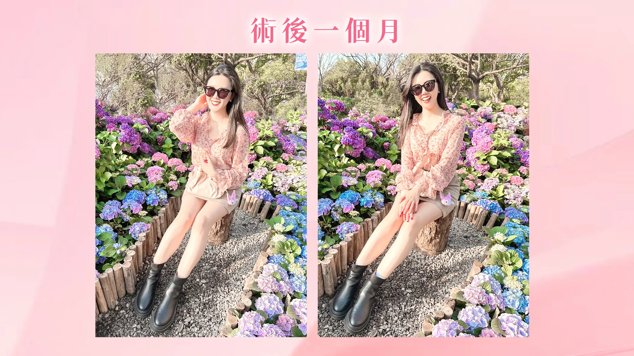 晶鑽診所 戰斧音波 術後一個月