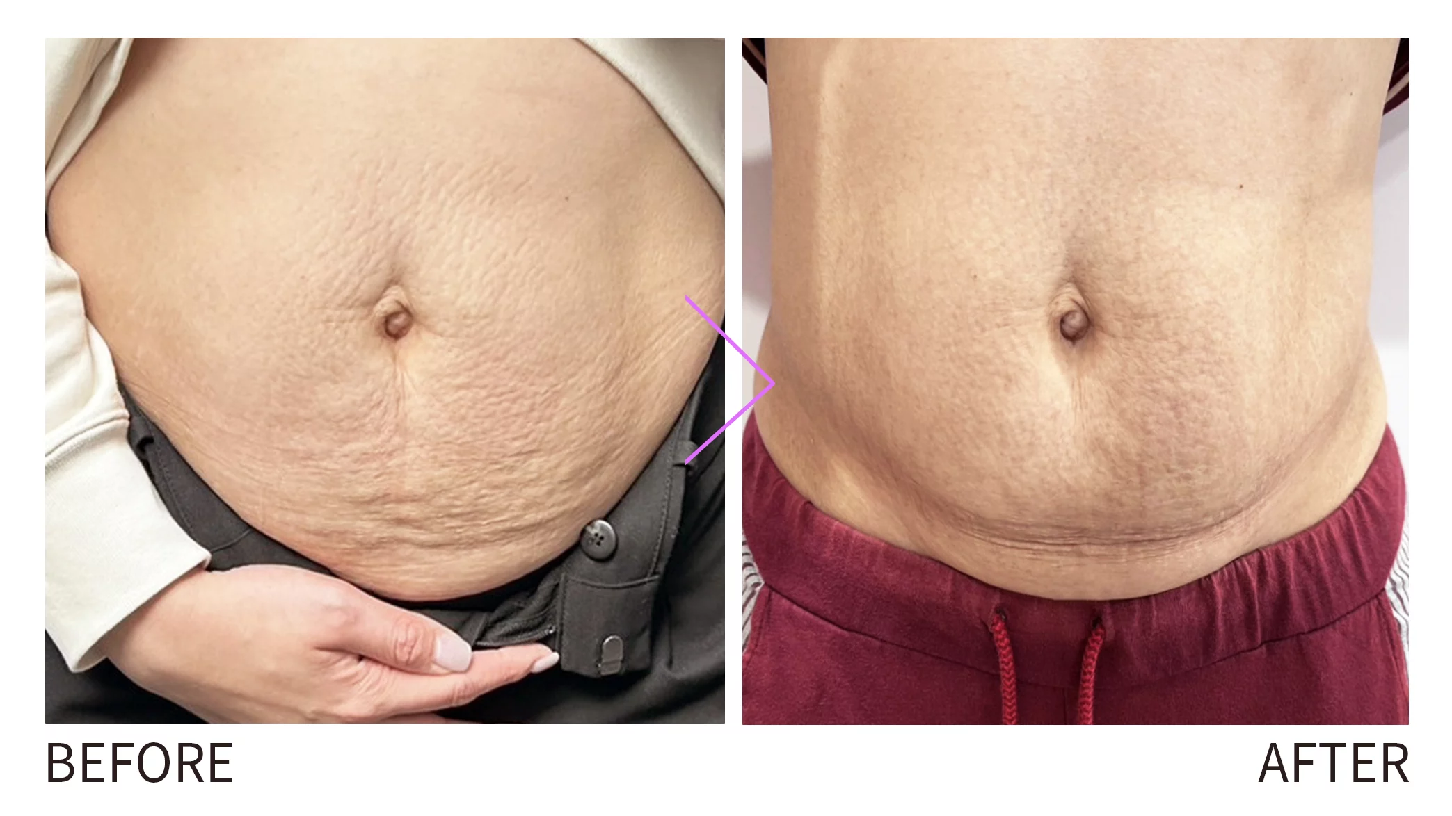 晶鑽診所＿妊娠紋改善 見證圖  妊娠紋改善 妊娠紋治療