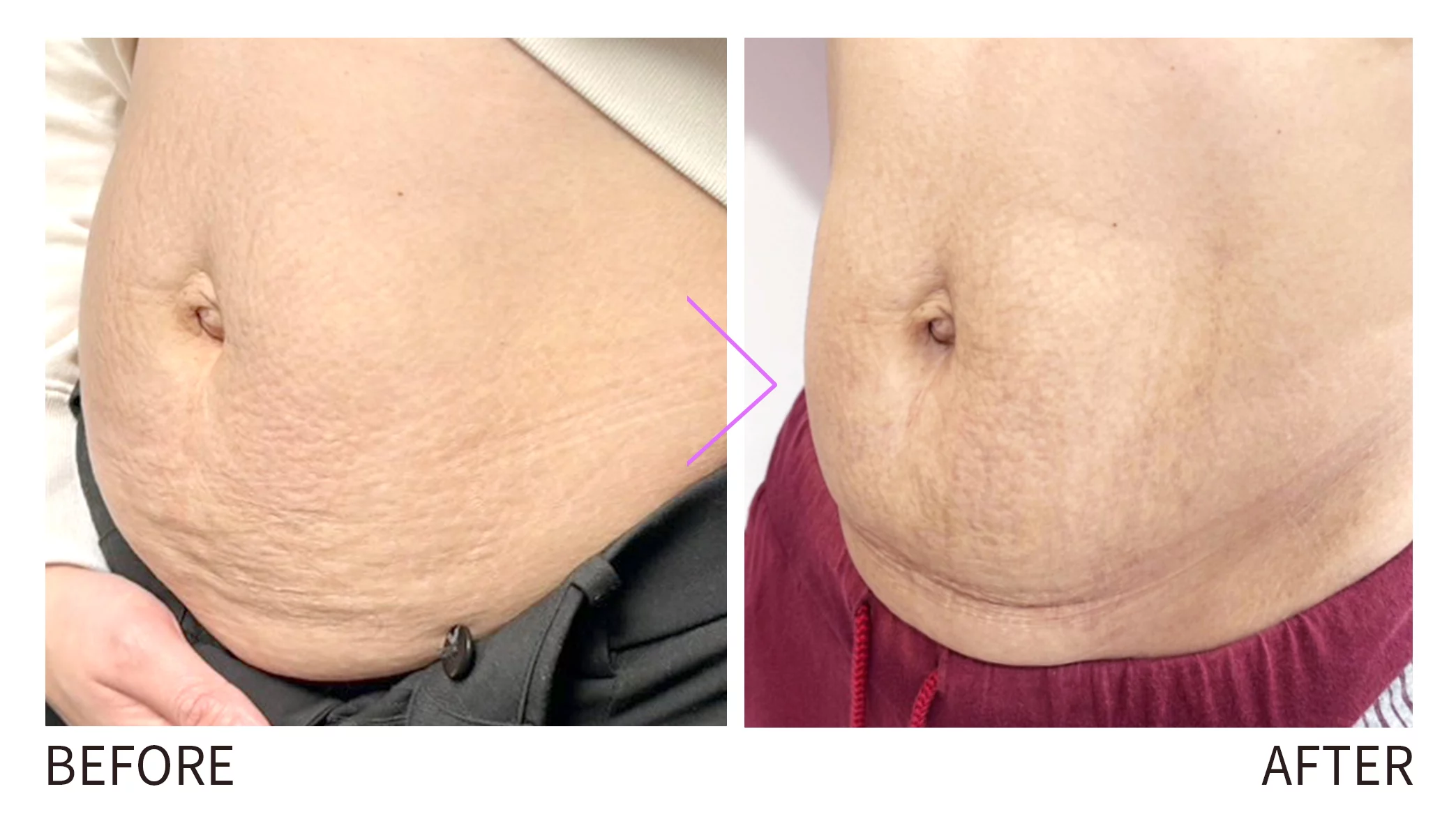 晶鑽診所＿妊娠紋改善 見證圖  妊娠紋改善 妊娠紋治療