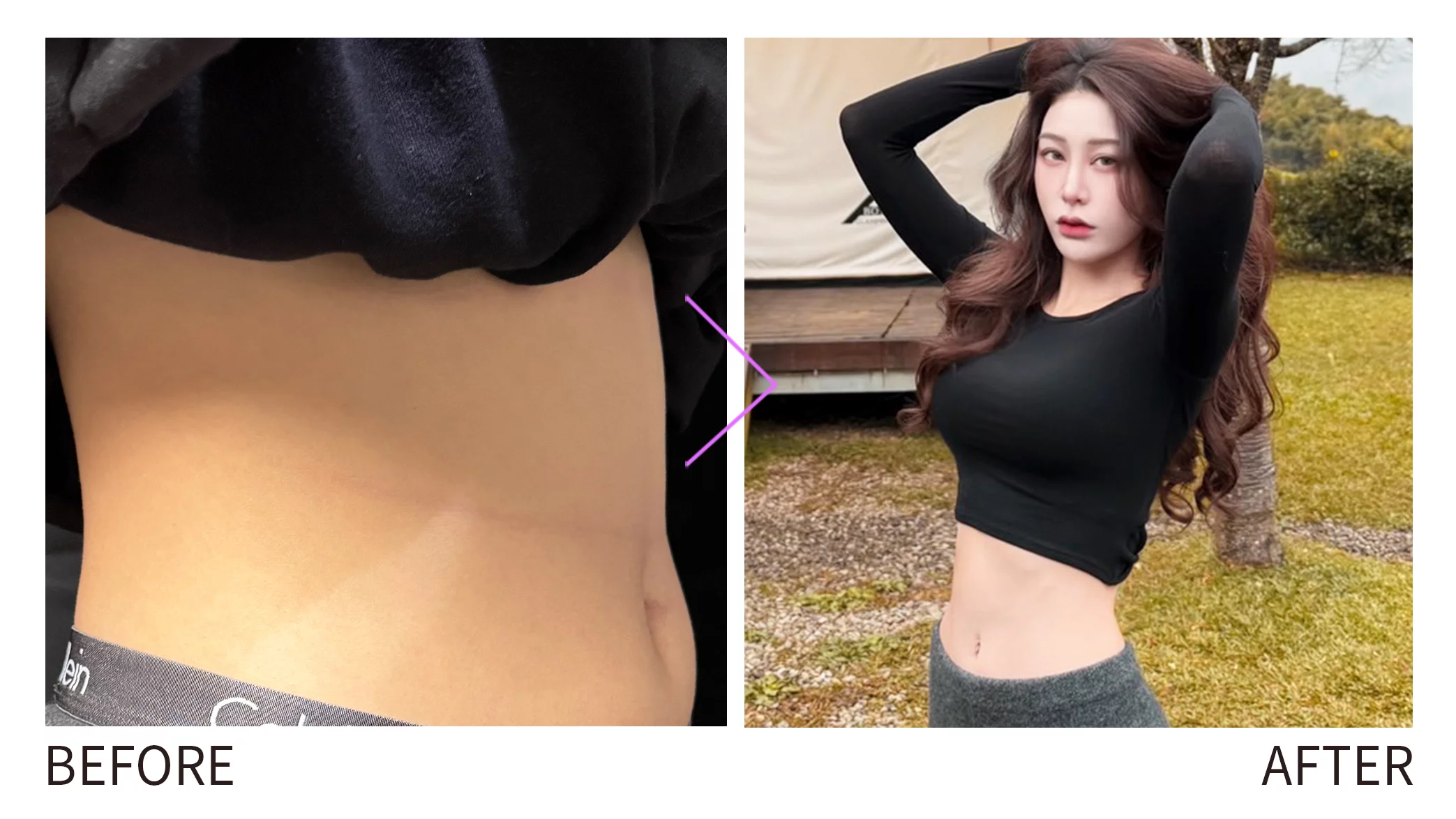 晶鑽診所 戰斧音波 夏日瘦身、音波容脂、免動刀溶脂、腹部消脂