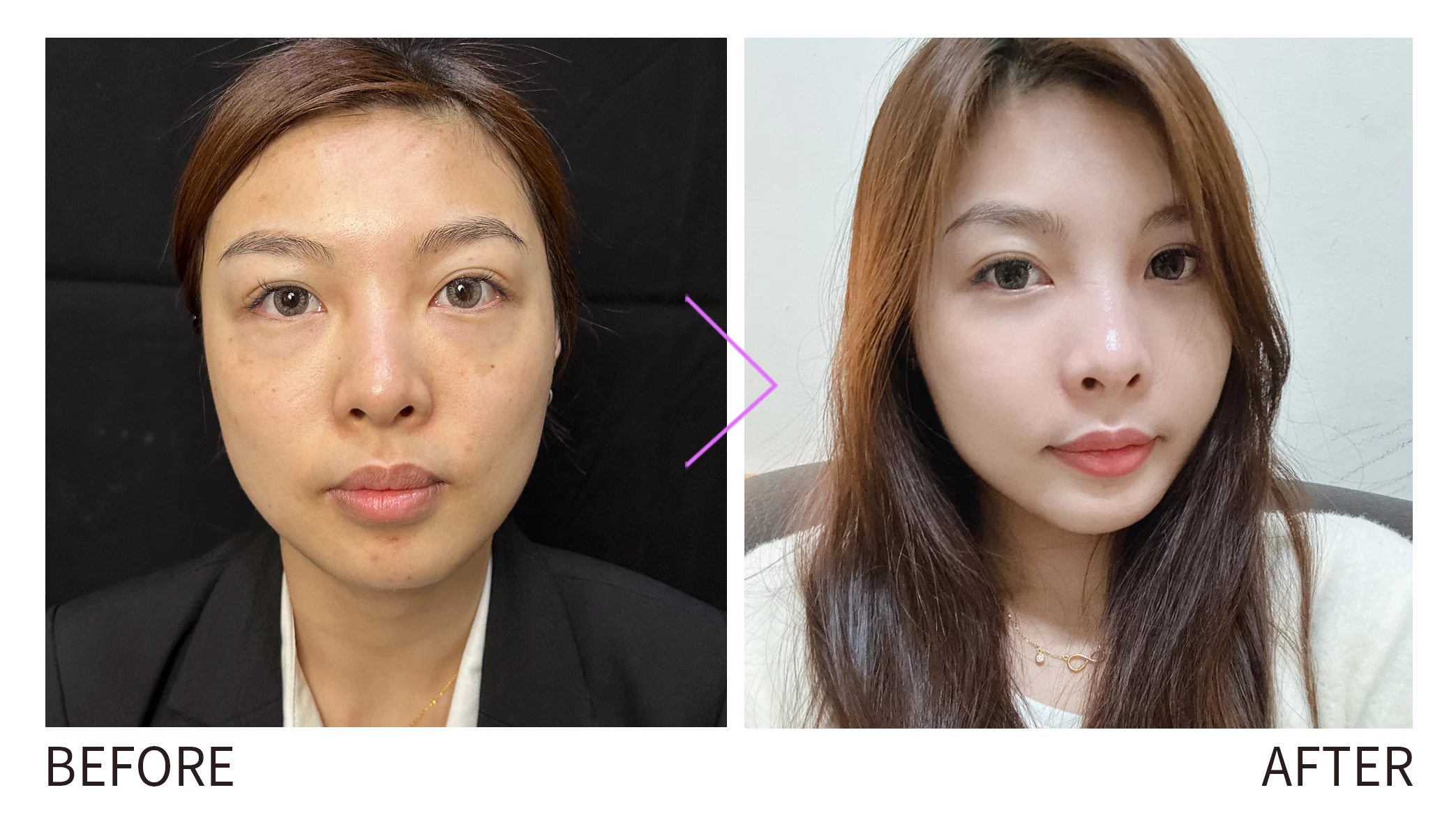 晶鑽診所 玻尿酸填補、改善氣色、修飾臉部輪廓、幼態臉