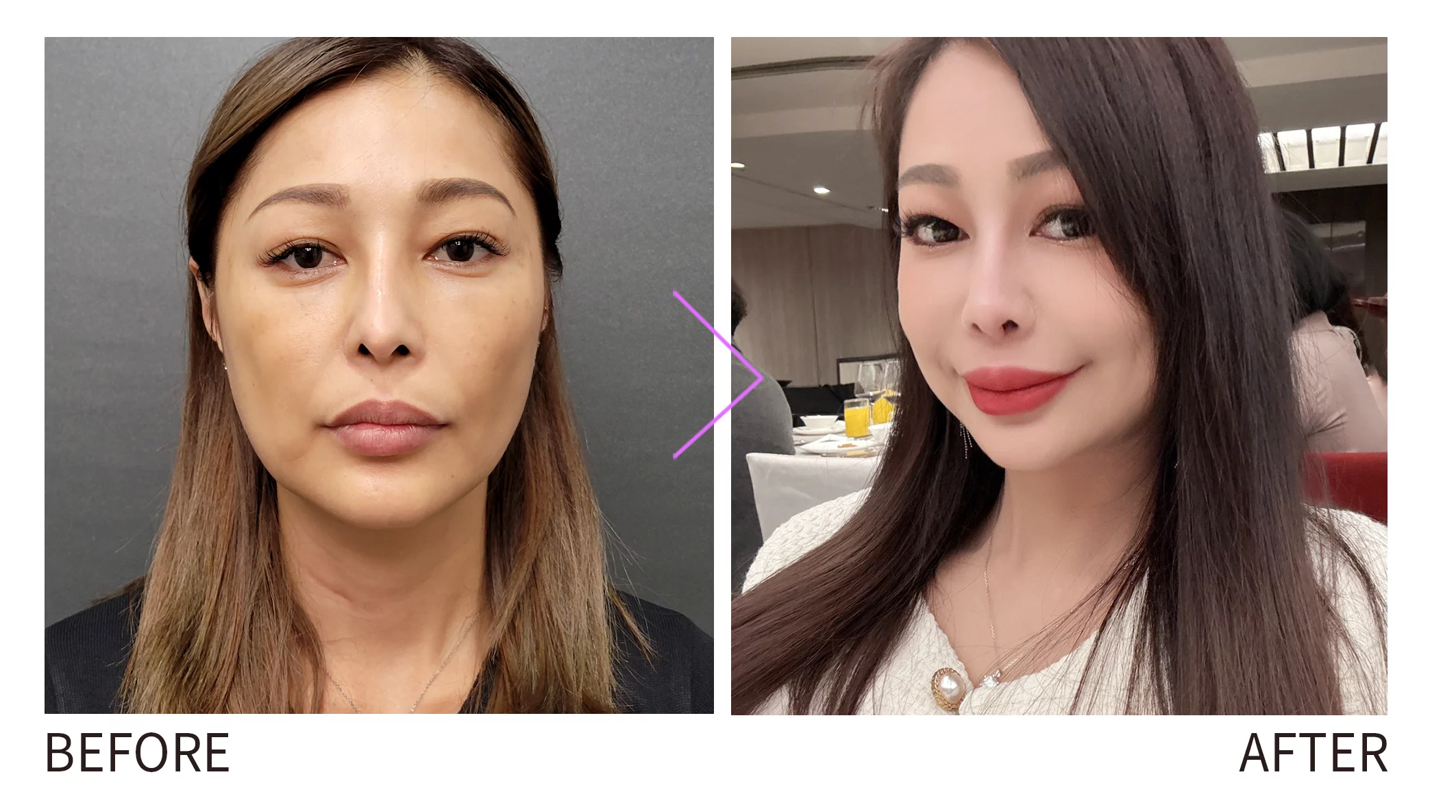 晶鑽診所 無痕拉提、膠原蛋白自然增生、修飾臉部輪廓、幼態臉、妮芙蕾體驗案例