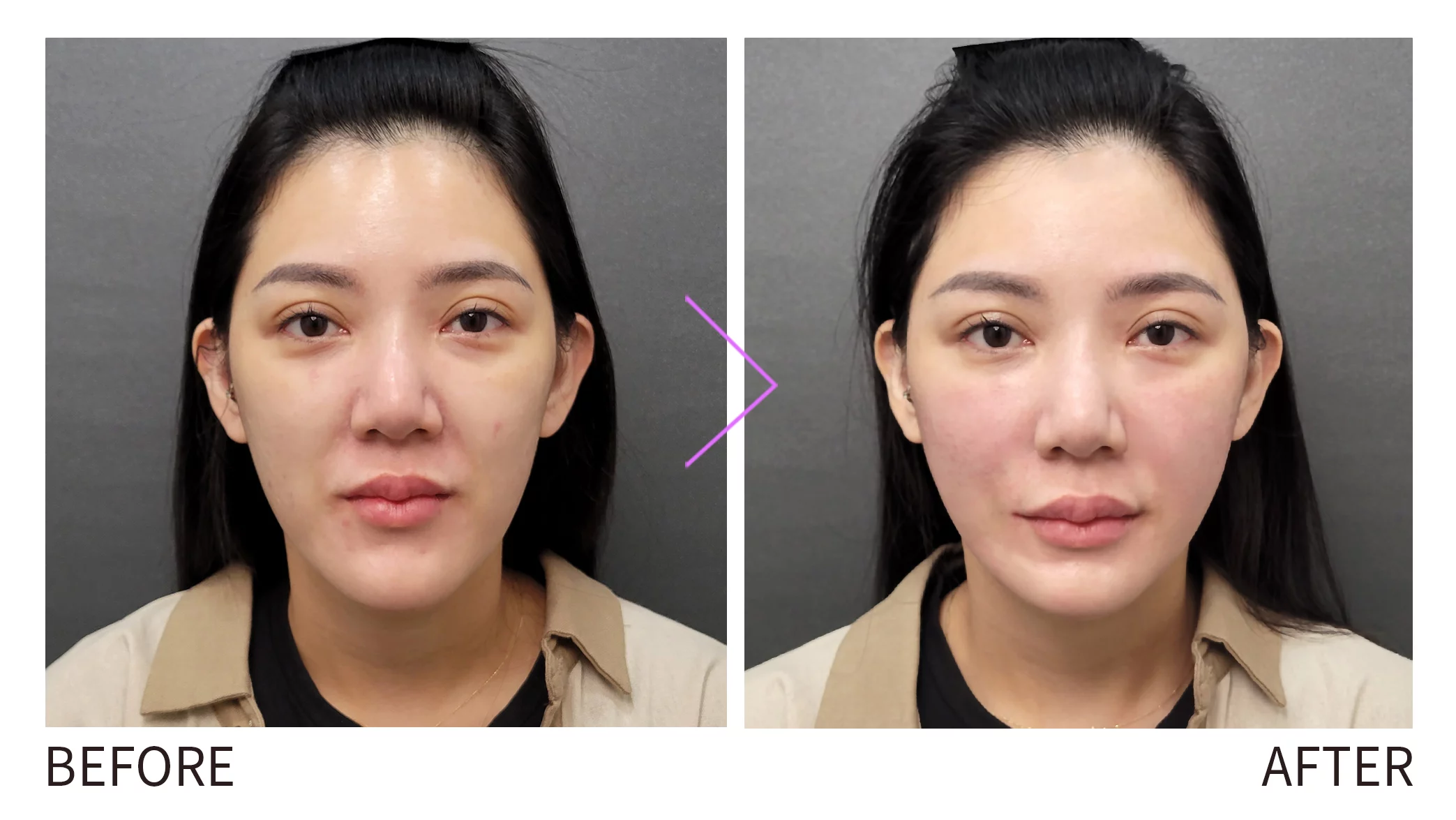 晶鑽診所 4D童妍針 改善法令紋 肌膚提亮