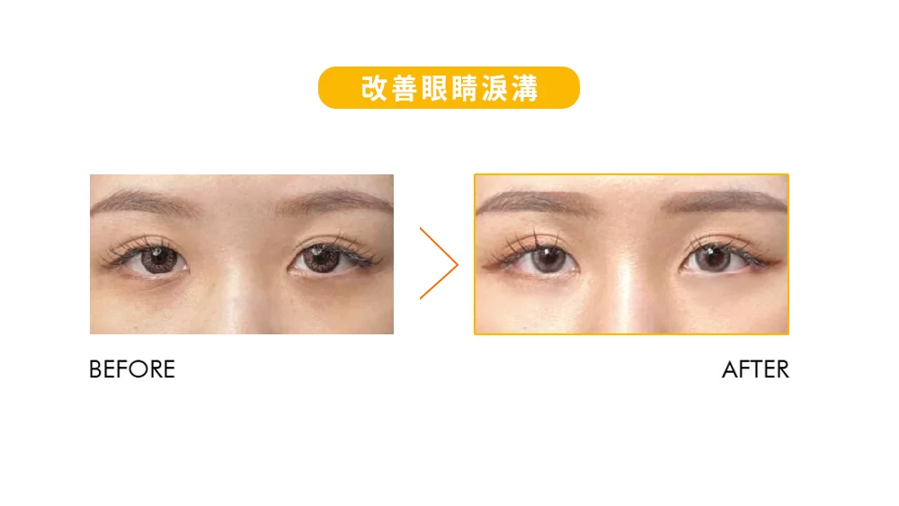 晶鑽診所 妮芙蕾 淚溝改善