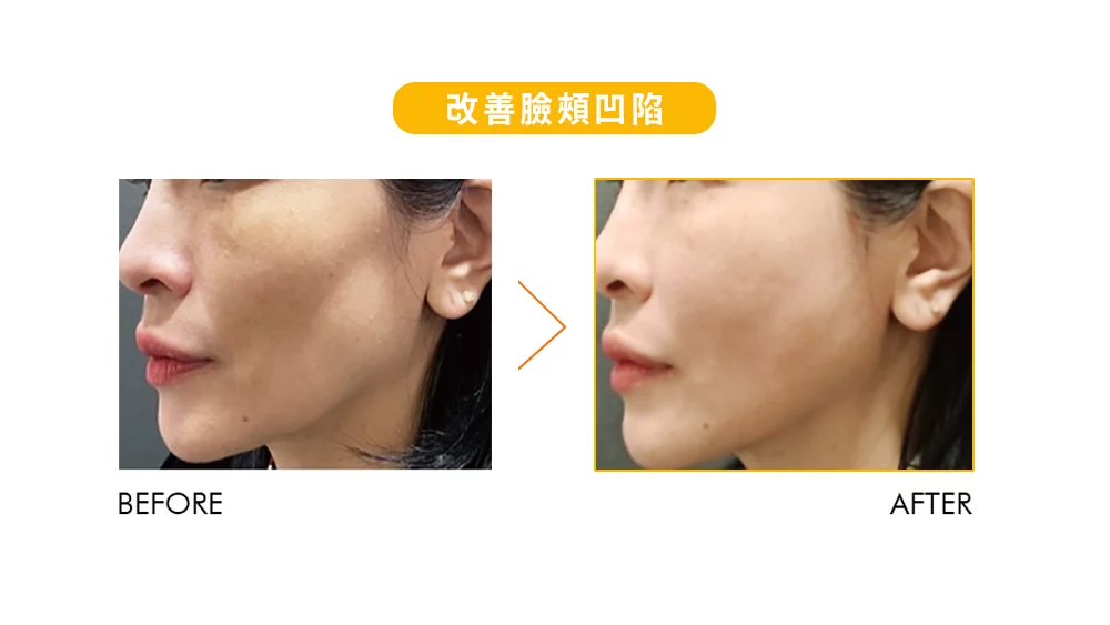 晶鑽診所 妮芙蕾 臉頰改善