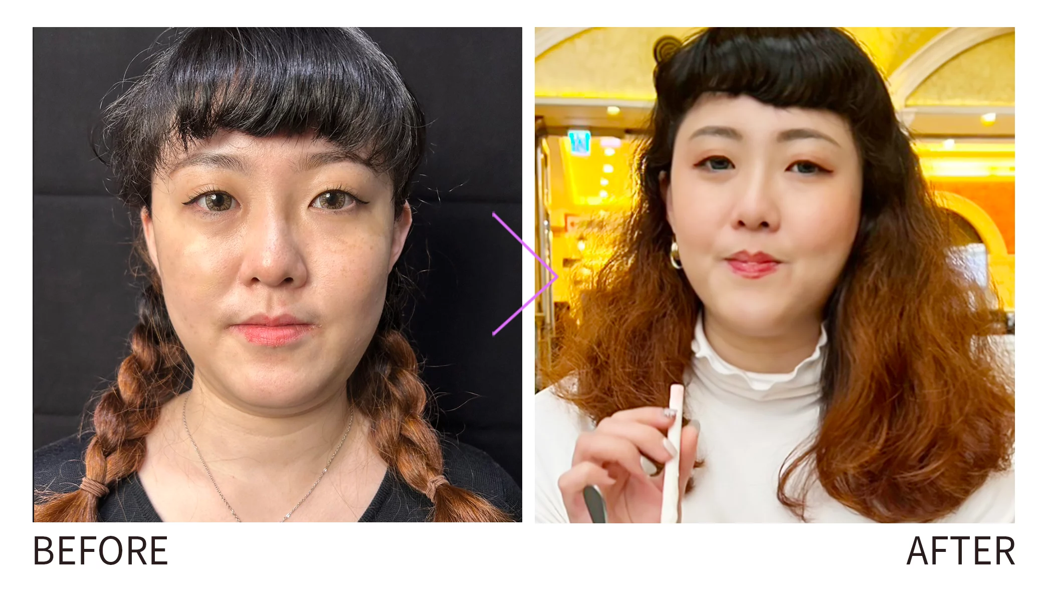 晶鑽診所 容脂針 瘦下巴　改善雙下巴