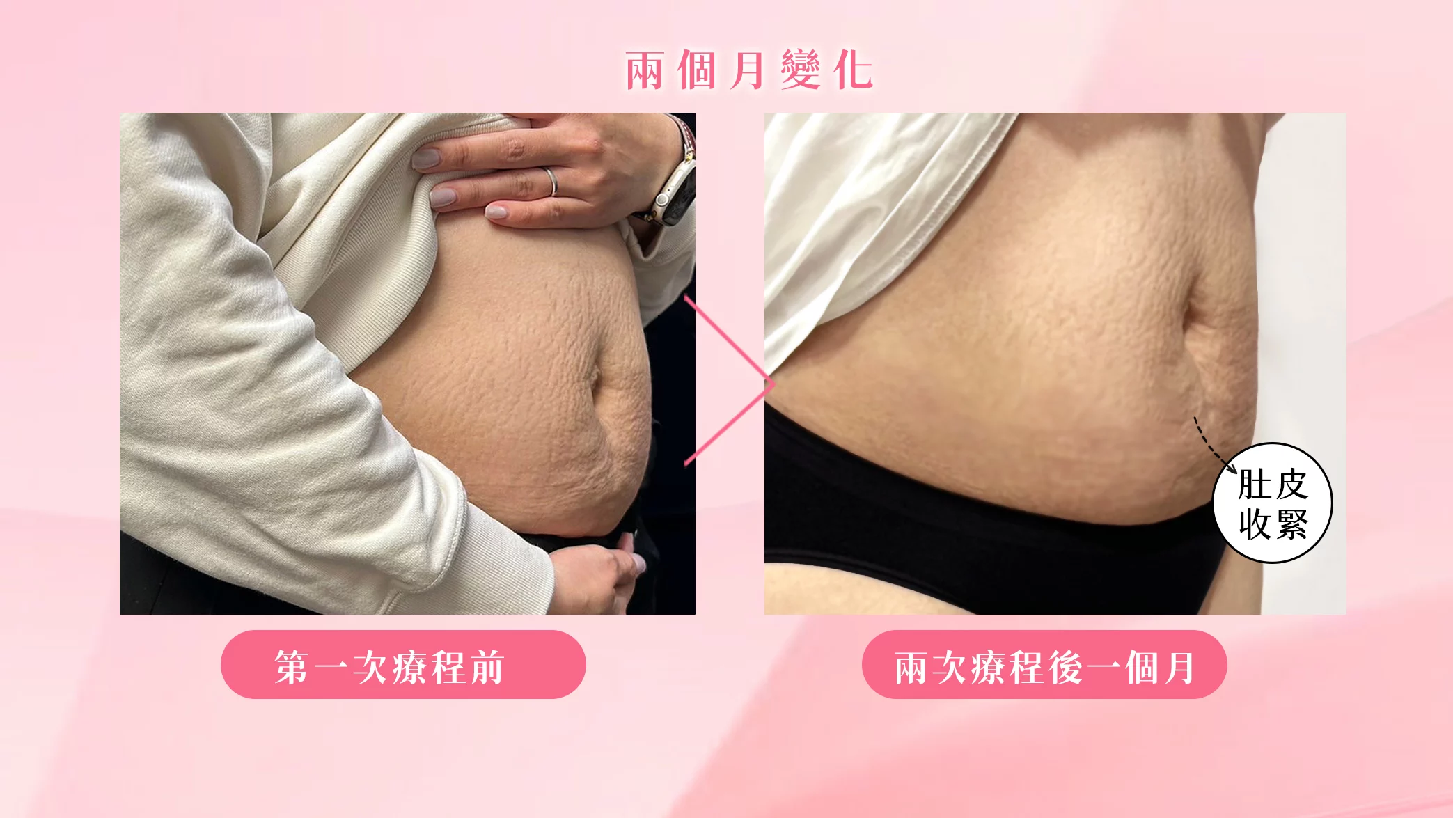晶鑽診所 戰斧音波見證