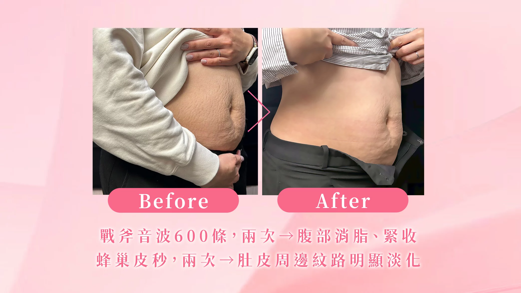 晶鑽診所 消除妊娠紋