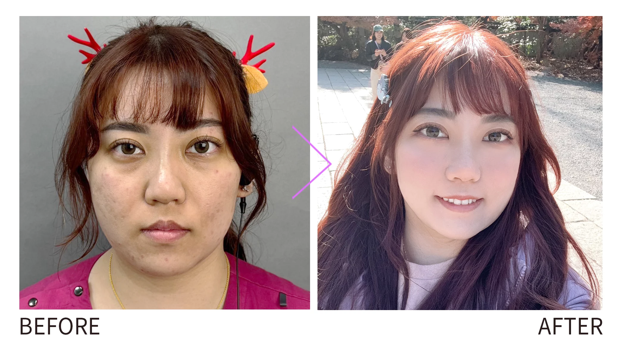 晶鑽診所 熊貓針 改善黑眼圈