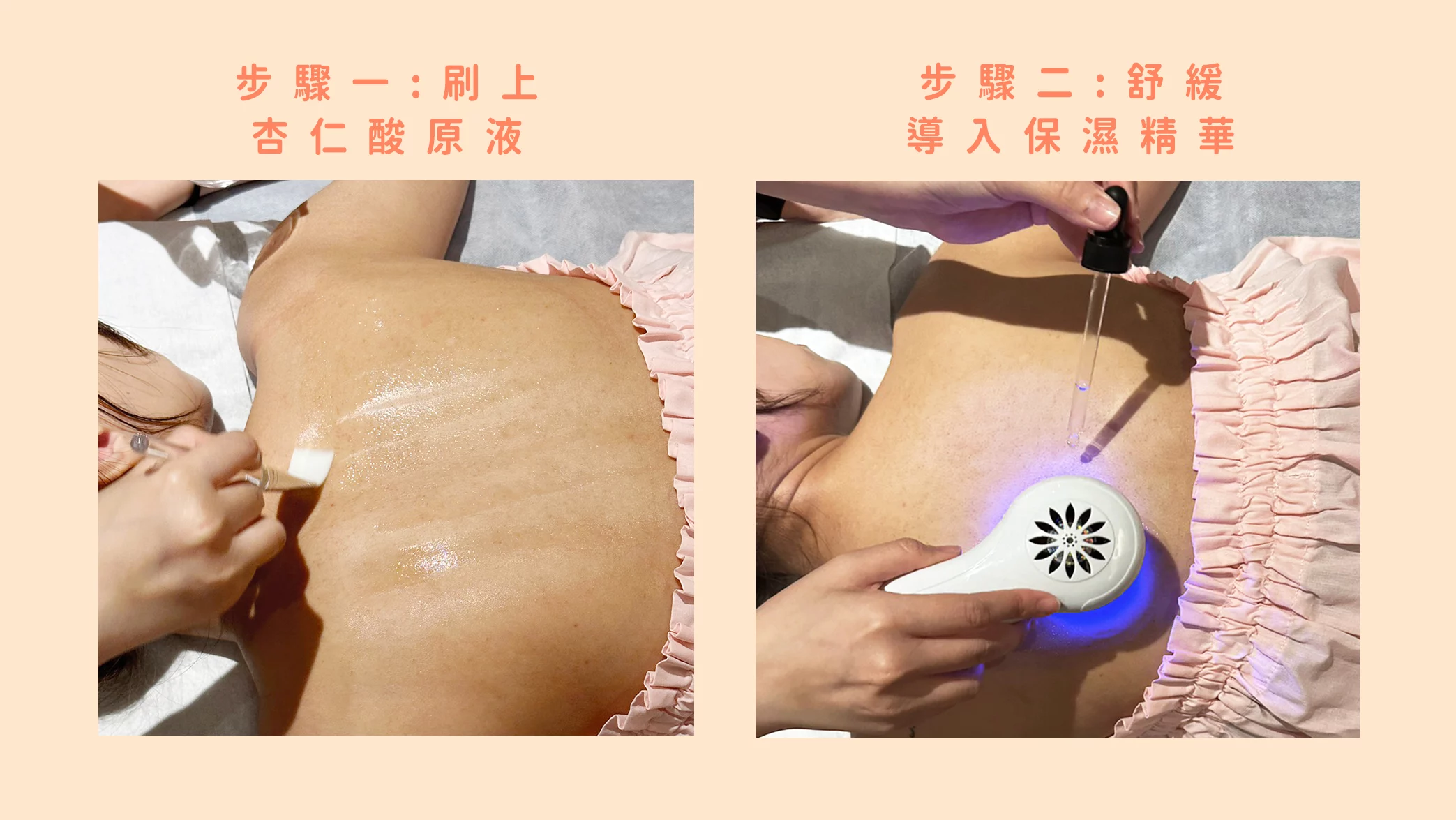 晶鑽診所 部痘痘、背部粉刺、杏仁酸煥膚、美背療程、杏仁酸保養