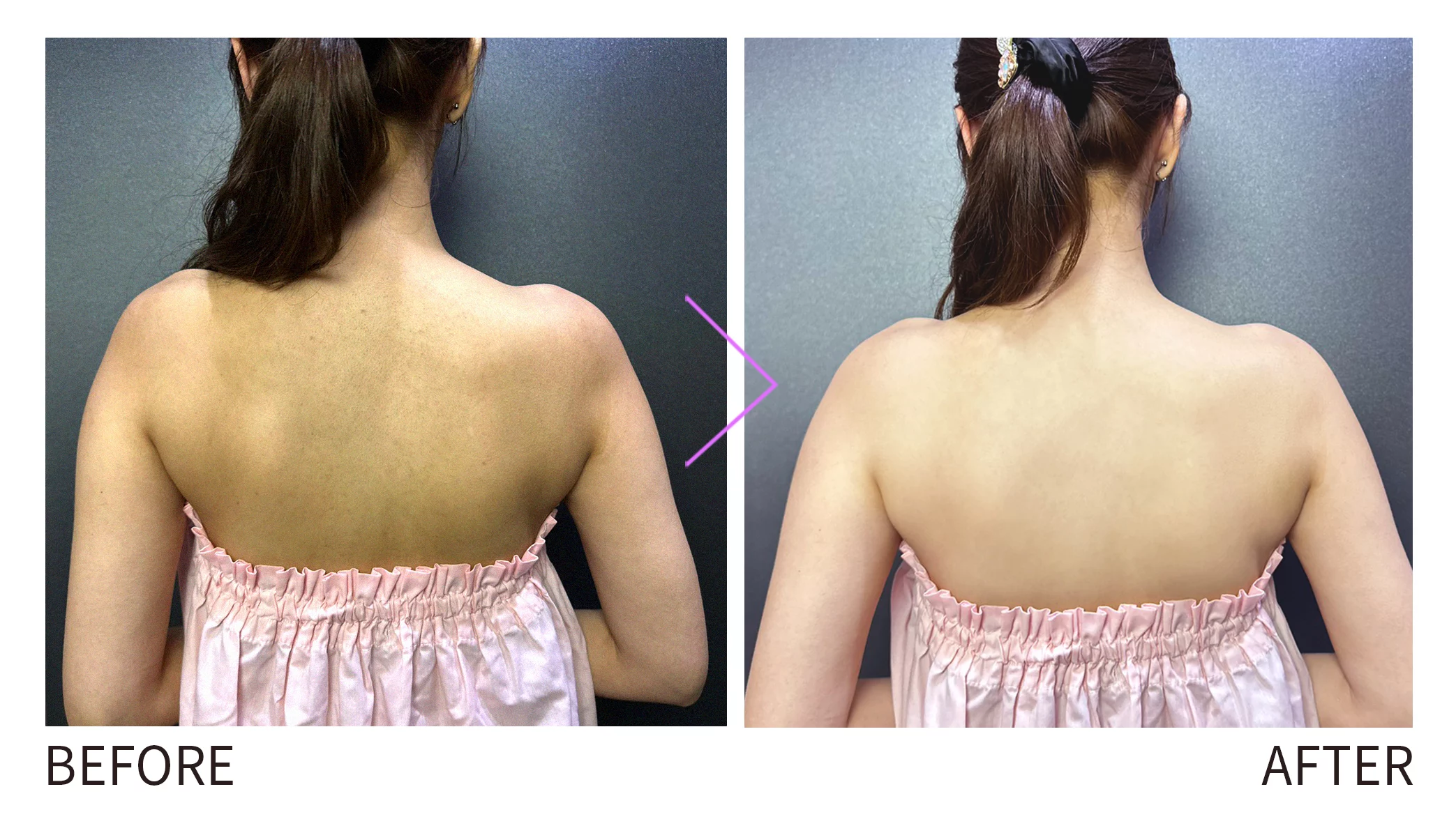 晶鑽診所 背部痘痘、背部粉刺、杏仁酸煥膚、美背療程、杏仁酸保養