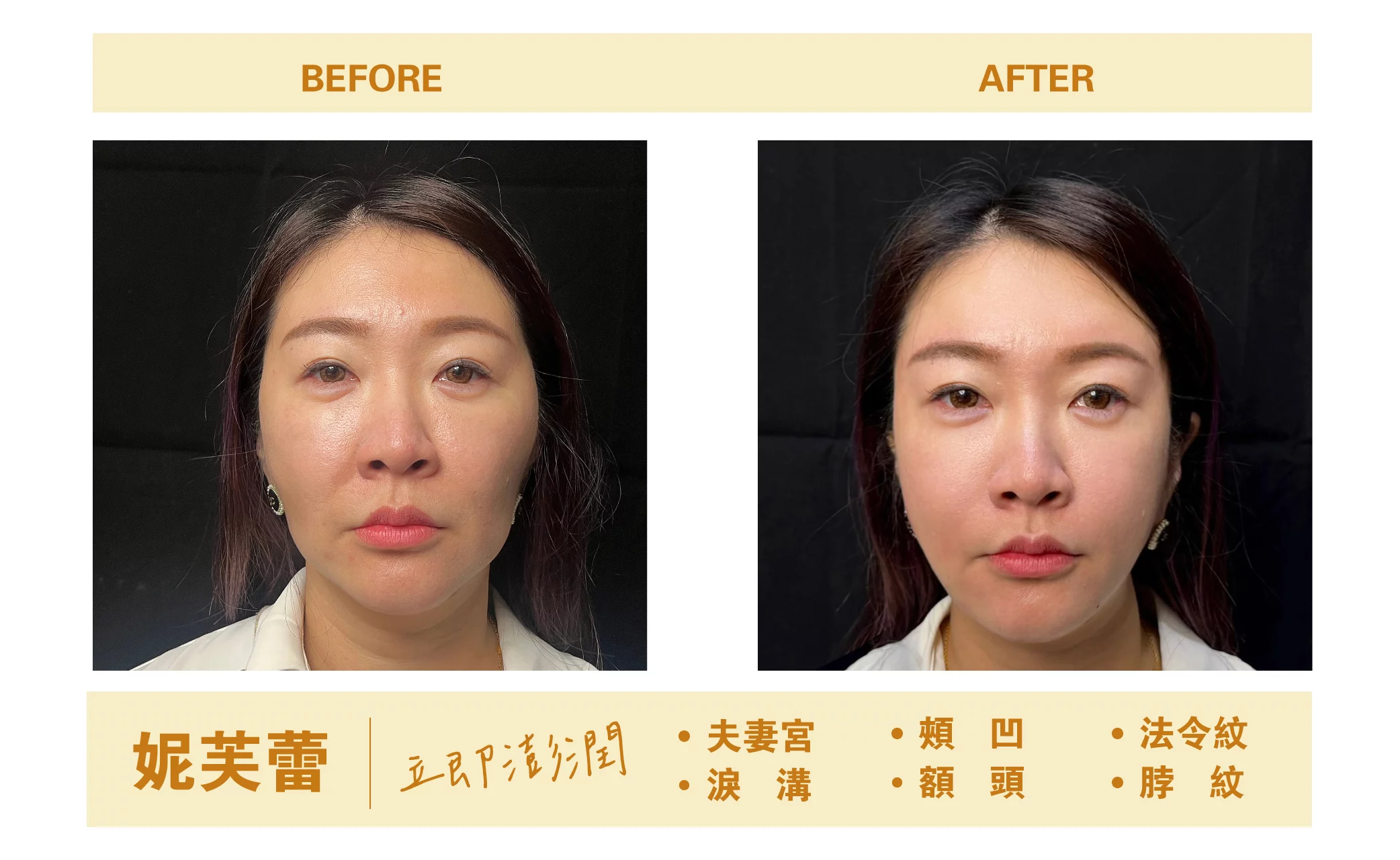 妮芙蕾BA照術前術後照