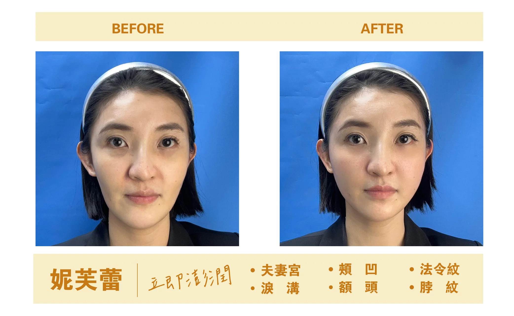 妮芙蕾BA照術前術後照1
