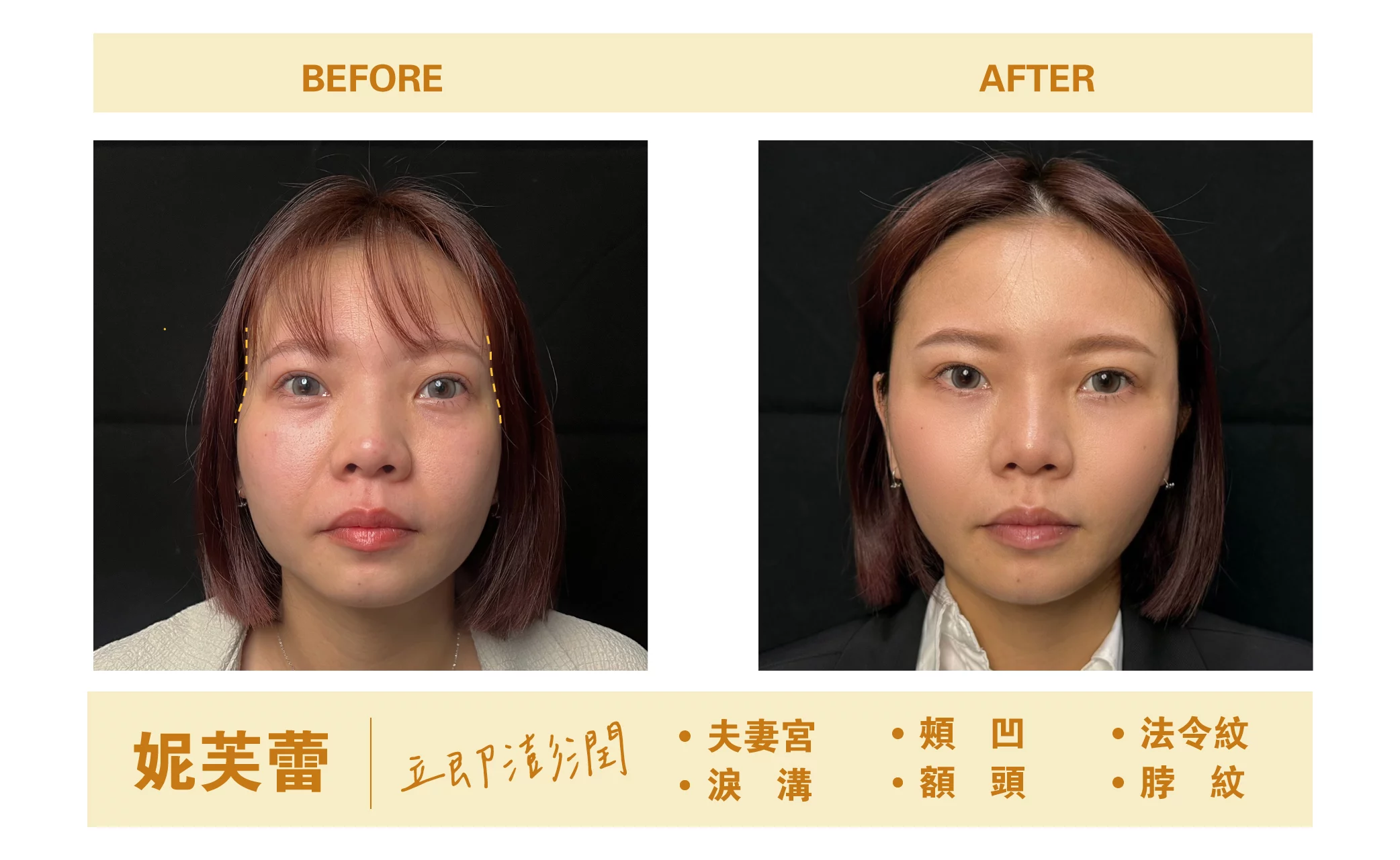 妮芙蕾BA照術前術後照2