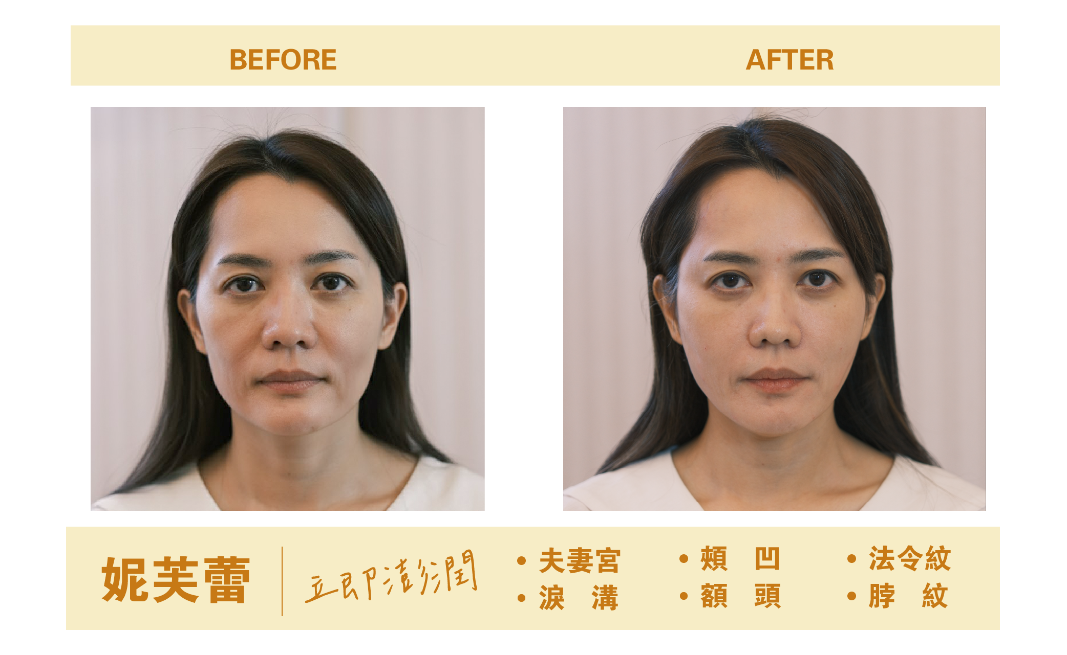 妮芙蕾BA照 膠原蛋白增生劑