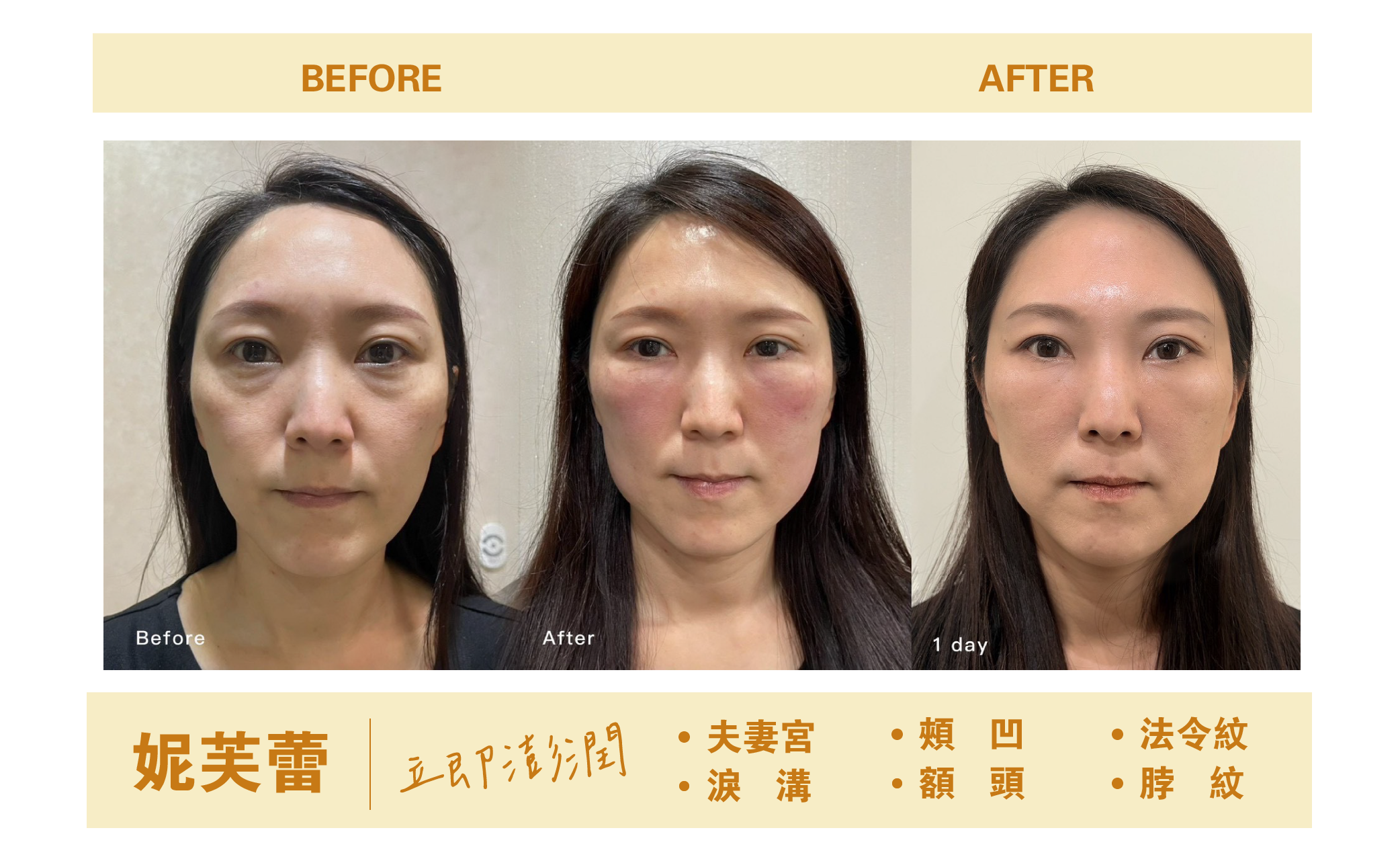 妮芙蕾BA照 膠原蛋白增生劑